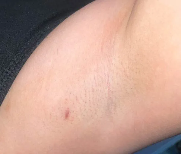 Cicatriz postoperatoria mínima invasión